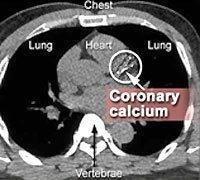 coronary-calcium-one.jpg