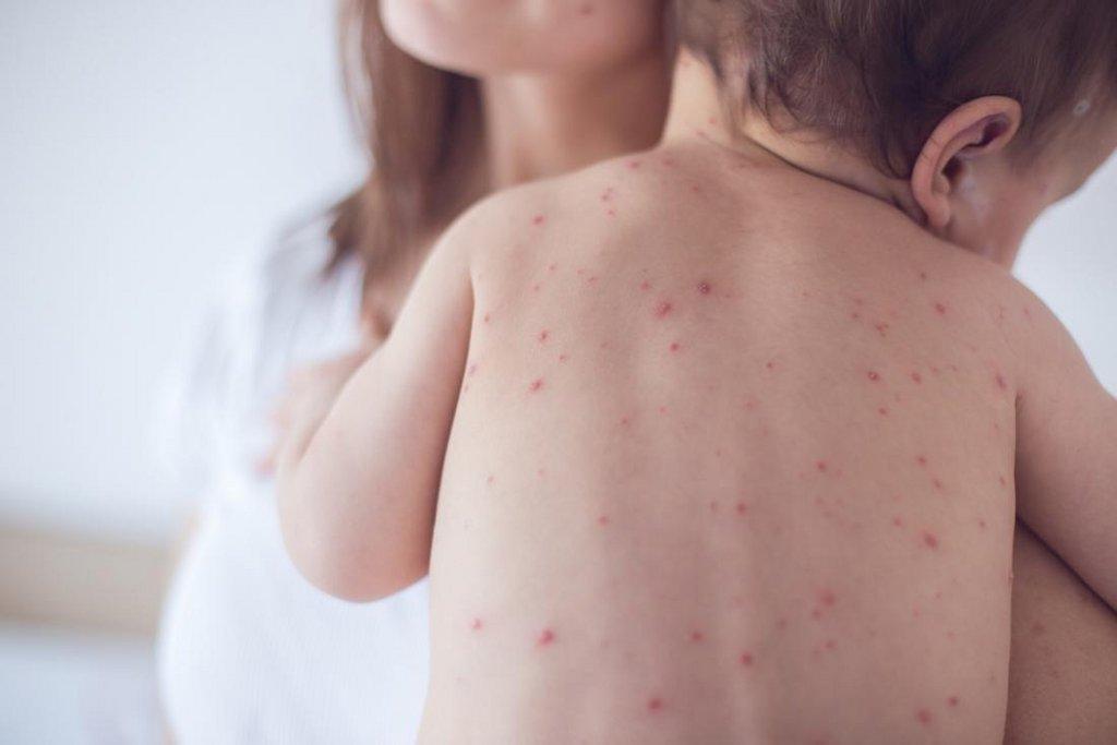 measles-spot.jpg